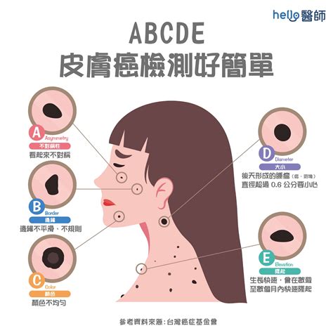 屁股長黑痣|皮膚長痣、長斑是皮膚癌前兆？皮膚癌初期4大症狀快。